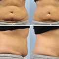 Coolsculpting-q13.jpg