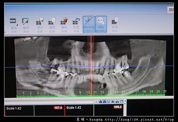 【新竹植牙推薦】植牙術前評估 20年豐富臨床經驗|日光翡麗牙醫診所