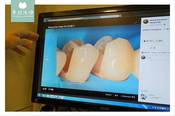 【頂尖陶瓷嵌體技術】如拼圖般補上牙齒的缺損處 依德牙科美學中心 