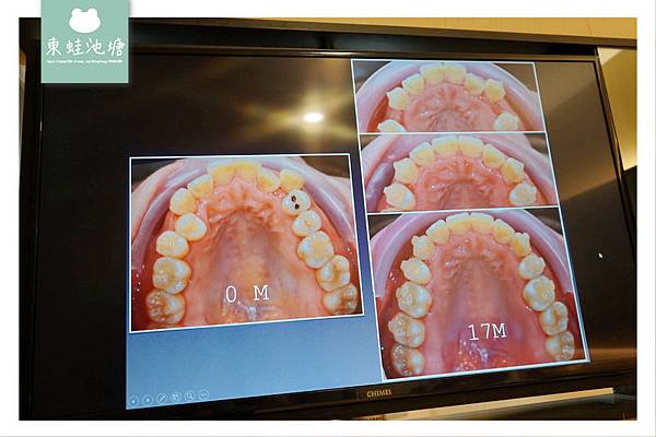 【中壢隱形矯正牙套推薦】亞洲領導品牌 時代天使透明矯正 環宇數位牙醫診所