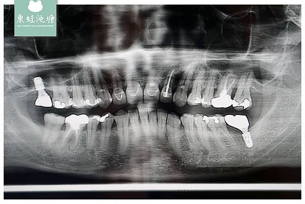 【桃園藝文特區植牙推薦】3D口掃取模超方便 裝設牙冠心得分享 藝品牙醫診所