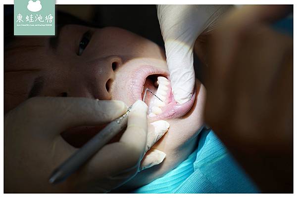 開箱心得 好店推薦 台北人工植牙專科推薦 美國波士頓大學牙周病專科林士峻醫師細心詳細牙周病檢查過程優政牙醫診所