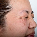 【麗波永康國際診所】PICOPLUS皮秒雷射 不讓歲月在臉上留下痕跡