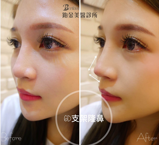 桃園醫美 竹北醫美 鉑金美醫診所 美鼻神助攻 6d埋線鼻雕幫妳搭上美鼻風潮 鉑金美醫診所 桃園醫美 竹北醫美診所