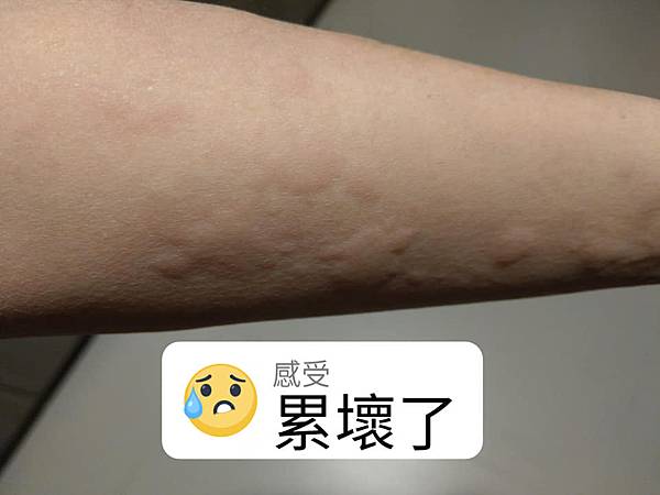 蕁麻疹1.jpg
