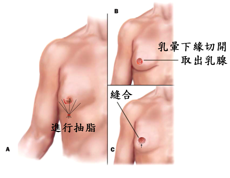 取乳腺+抽脂手術示意圖.png