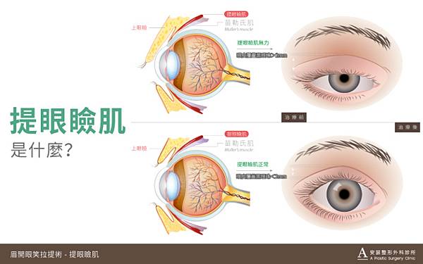 提眼瞼肌案例_官網-04-768x480.jpg