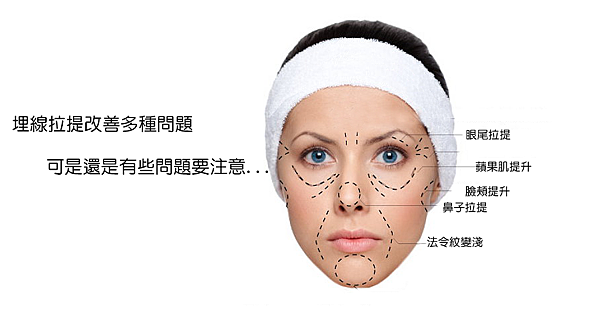 埋線拉提埋線.png 埋線拉提埋線.png