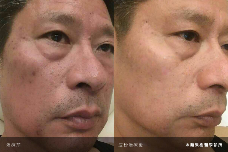 蘋果樹醫美診所姚肖全醫師755蜂巢皮秒雷射二代皮秒皮秒雷射蜂巢透鏡PicoSureFocus圖片03.jpg