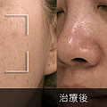 肝斑2