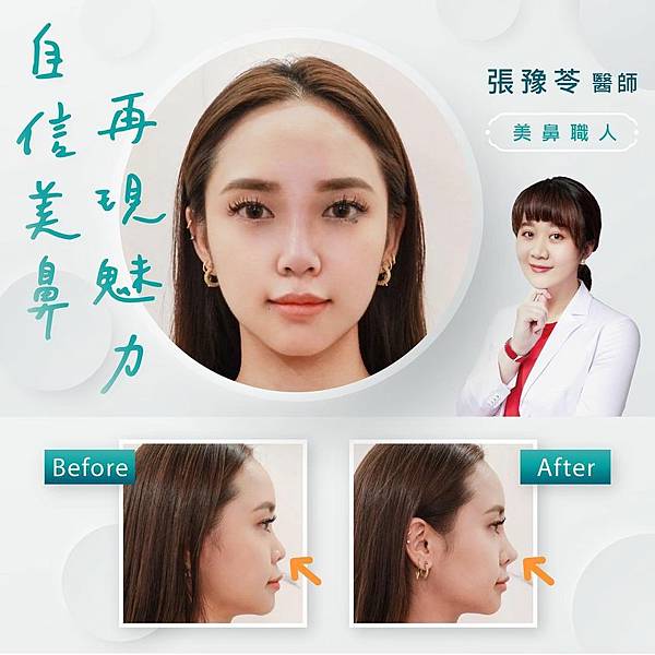 張豫苓 隆鼻.jpg
