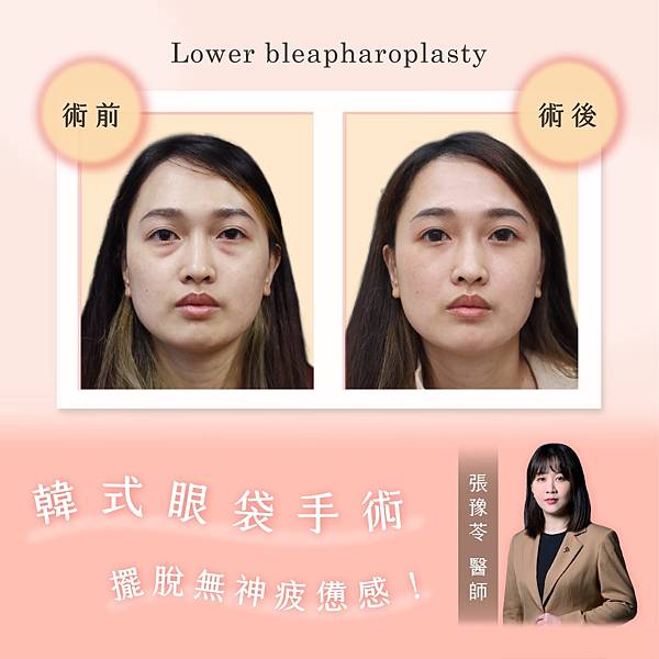 張豫苓醫師 眼袋手術案例