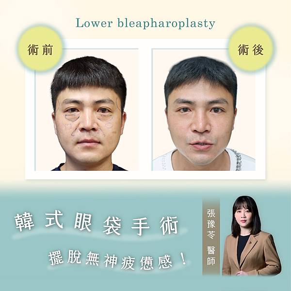 眼袋不見變超帥！張豫苓醫師眼袋手術案例