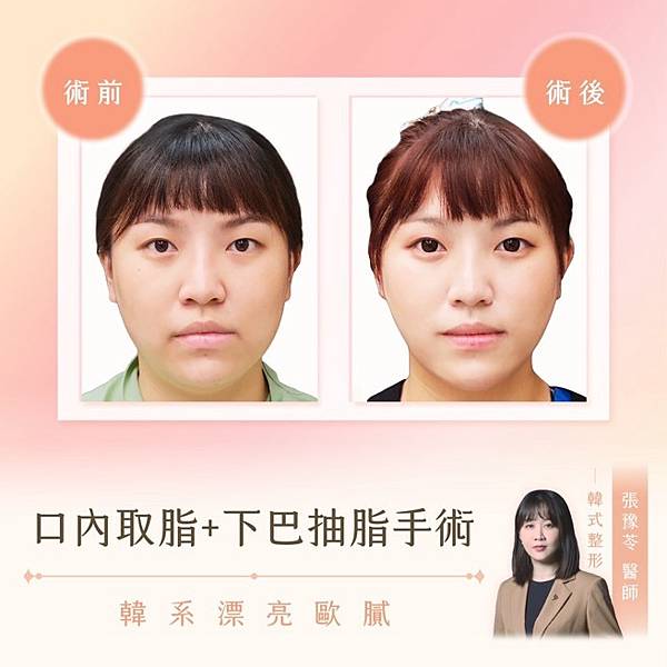 消除嘴邊肉,打造小V臉