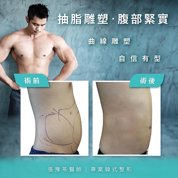 男性抽脂雕塑，伴侶幸福的開始！！