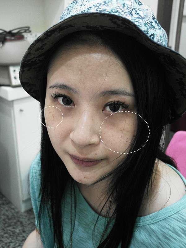 雷射除斑除粉刺 拯救斑點女孩女人就該乾乾淨淨才能惹人愛 台中超仁醫美診所 超仁診所 台中減重體雕 皮膚雷射微整 雷射除斑除粉刺 拯救斑點女孩女人就該乾乾淨淨才能惹人愛 台中超仁醫美診所 超仁診所 台中減重體雕 皮膚雷射微整