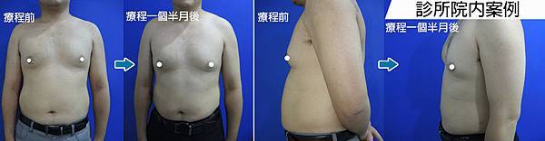 超仁診所消脂針小腹案例