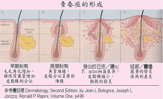 青春痘形成