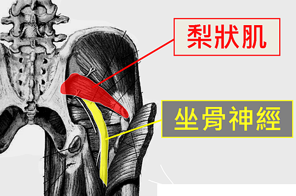 Homepage-case003-piriformis-syndrome-pic2