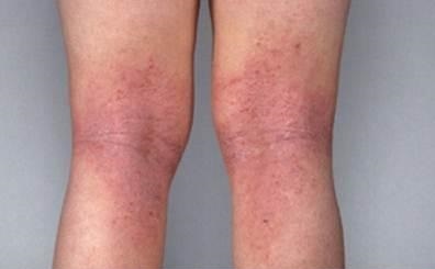 atopicdermatitis1337619927938