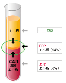 「關節炎 PRP注射」的圖片搜尋結果