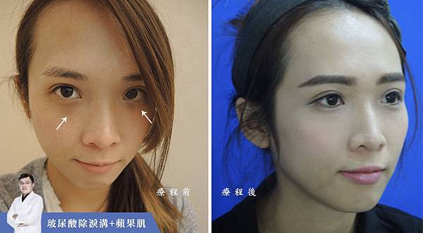 玻尿酸+蘋果肌對比