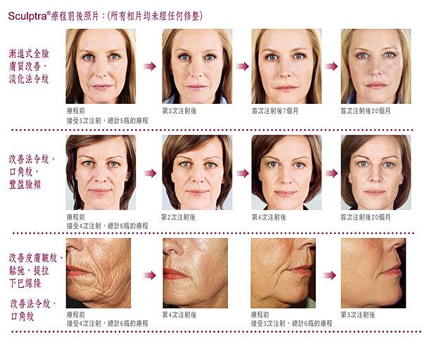 sculptra療程前後照片0(2)-3de4f51440