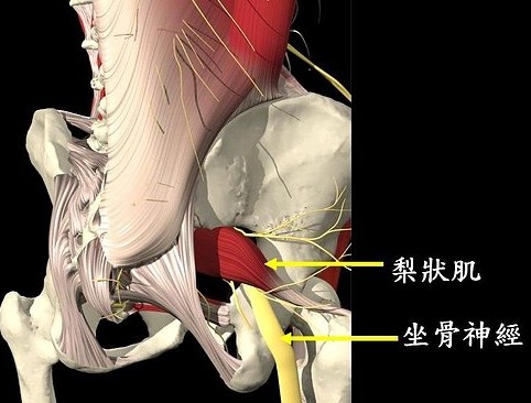 梨狀肌症候群---假性坐骨神經痛