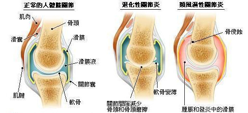 類風濕性關節炎