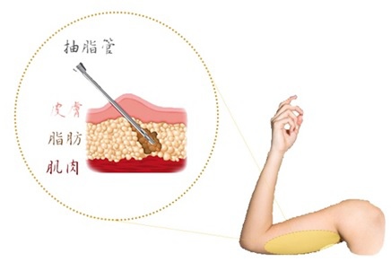 抽脂手背示意