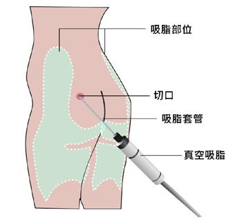 大腿抽脂示意