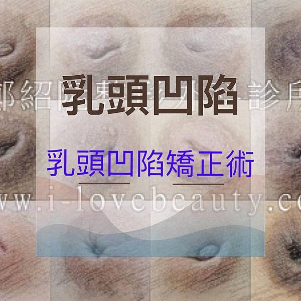 乳頭凹陷矯正術. 鄭紹隆診形外科診所.jpg