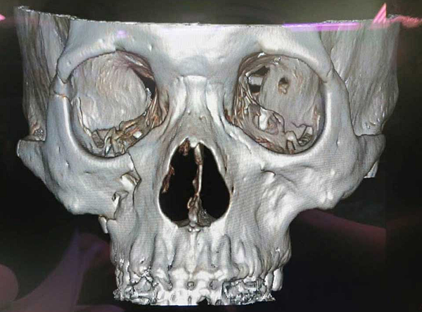 陳怡傑醫師 從顴骨骨折的治療觀點談顴骨削骨手術 群英整形外科診所 痞客邦 陳怡傑醫師 從顴骨骨折的治療觀點談顴骨削骨手術 群英整形外科診所 痞客邦