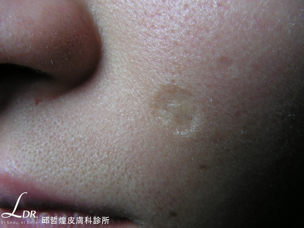 Case2-凹陷性疤痕-腐蝕性化學物點痣 (1).JPG