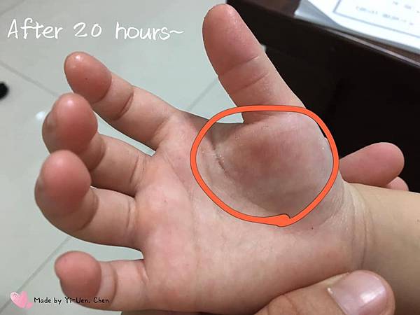 阿嚕燙傷好了.jpg
