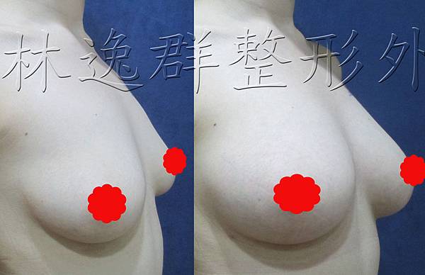 1512xx脂肪隆乳半年右45面拷貝.jpg 1512xx脂肪隆乳半年右45面拷貝.jpg
