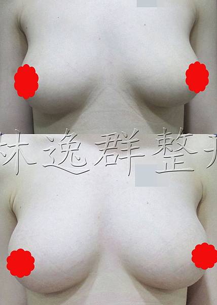 1512xx脂肪隆乳半年正面拷貝.jpg 1512xx脂肪隆乳半年正面拷貝.jpg