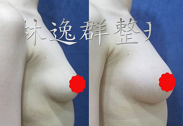 1512xx脂肪隆乳半年右側面拷貝.jpg