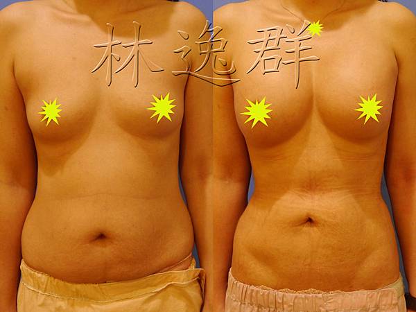 170123腹部環抽三個月正面拷貝.jpg 170123腹部環抽三個月正面拷貝.jpg