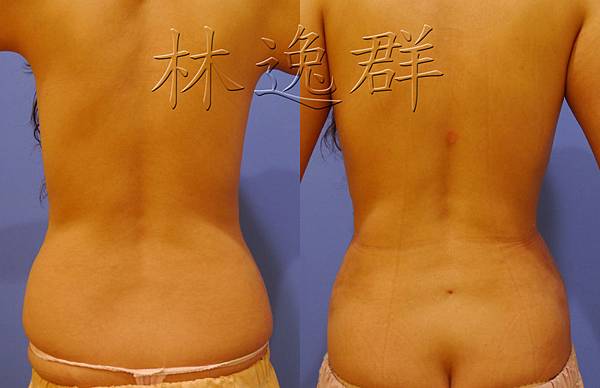 170123腹部環抽三個月背面拷貝.jpg 170123腹部環抽三個月背面拷貝.jpg