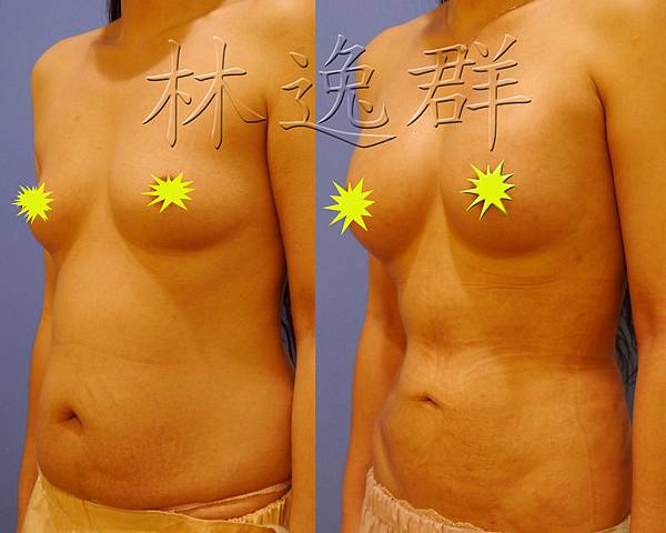 170123腹部環抽三個月左45面拷貝.jpg 170123腹部環抽三個月左45面拷貝.jpg