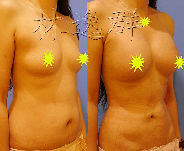 170123腹部環抽三個月右45面拷貝.jpg 170123腹部環抽三個月右45面拷貝.jpg