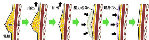 gynecomastia02.jpg