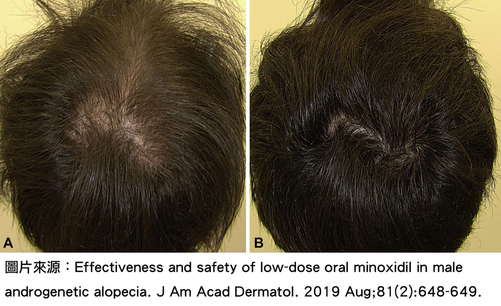 Effectiveness and safety of low-dose oral minoxidil in male androgenetic alopecia.jpg