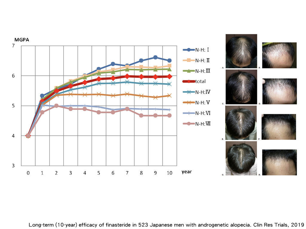 finasteride治療雄性禿10年的追蹤報告.jpg