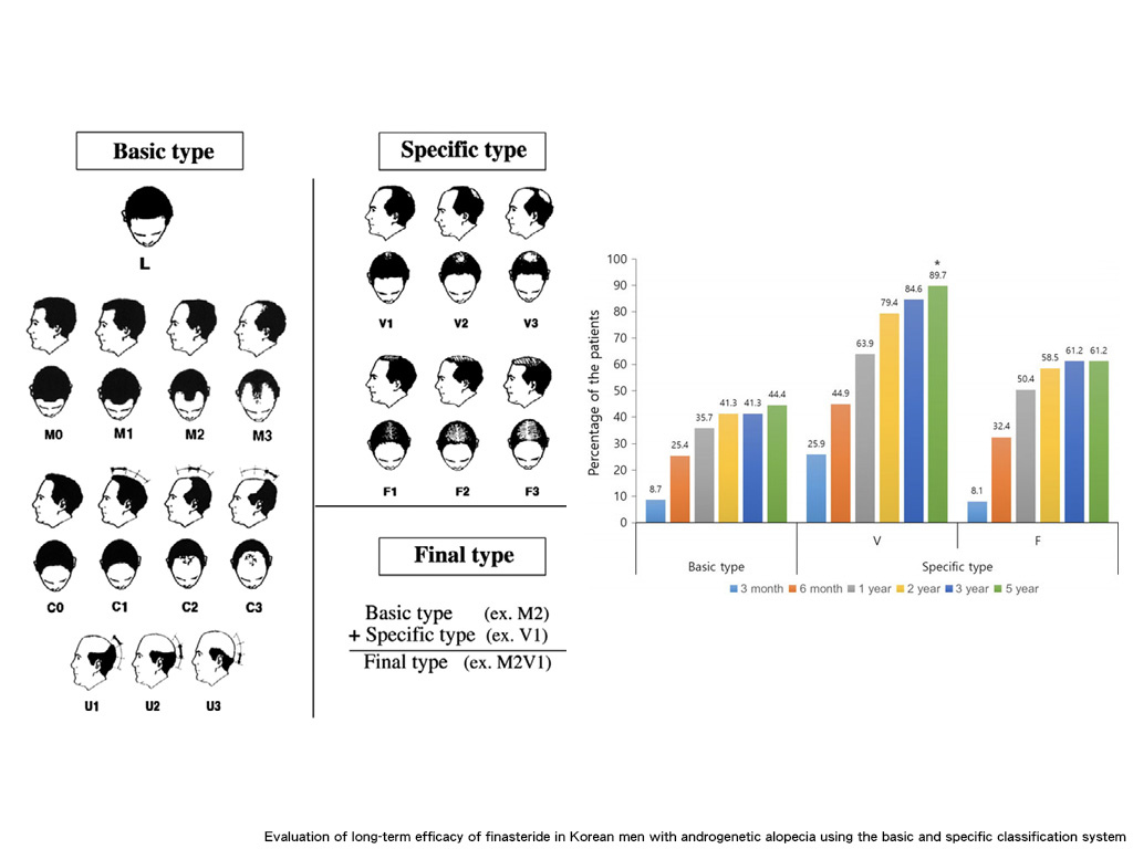 Evaluation of long-term efficacy of finasteride in Korean men with androgenetic alopecia using the basic and specific classification system.jpg