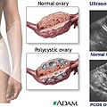 多囊性卵巢症候群.jpg