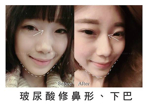 【素人分享】搶救鼻子大作戰– 看醫美小叮噹 黃雍宗醫師 如何解決小護士的煩惱!!!!! 【素人分享】搶救鼻子大作戰– 看醫美小叮噹 黃雍宗醫師 如何解決小護士的煩惱!!!!!