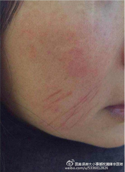 【醫學美容】膠原蛋白流失、雙下巴 、局部皺紋、臉頰鬆弛、眉尾下垂 【醫學美容】膠原蛋白流失、雙下巴 、局部皺紋、臉頰鬆弛、眉尾下垂
