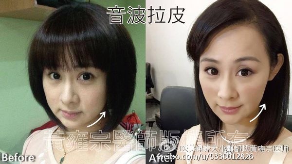 【醫學美容】膠原蛋白流失、雙下巴 、局部皺紋、臉頰鬆弛、眉尾下垂 【醫學美容】膠原蛋白流失、雙下巴 、局部皺紋、臉頰鬆弛、眉尾下垂